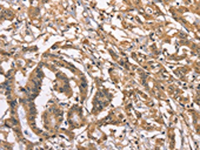 The image on the left is immunohistochemistry of paraffin-embedded Human colon cancer tissue using the antibody Antibody) at dilution 1/40, on the right is treated with fusion protein. (Original magnification: ×200)Rabbit anti-Human PEBP1 Polyclonal Antibody