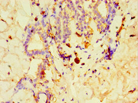 Immunohistochemistry of paraffin-embedded human breast cancer using GPS1 Antibody at dilution of 1:100Rabbit anti-Human GPS1 Polyclonal Antibody