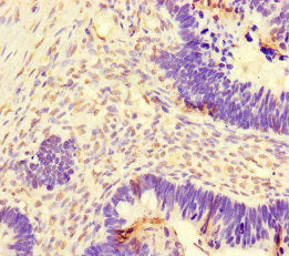 Immunohistochemistry of paraffin-embedded human ovarian cancer using the antibody at dilution of 1:100Rabbit anti-Human DNAJC3 Polyclonal Antibody