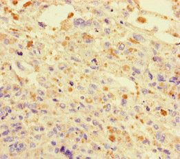 Immunohistochemistry of paraffin-embedded human melanoma using DNAJC3 Antibody at dilution of 1:100Rabbit anti-Human DNAJC3 Polyclonal Antibody