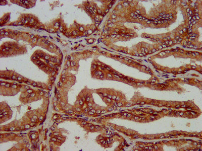 IHC image of the antibody diluted at 1:200 and staining in paraffin-embedded human prostate tissue performed on a Leica BondTM system. After dewaxing and hydration, antigen retrieval was mediated by high pressure in a citrate buffer (pH 6.0). Section was blocked with 10% normal goat serum 30min at RT. Then primary antibody (1% BSA) was incubated at 4°C overnight. The primary is detected by a biotinylated secondary antibody and visualized using an HRP conjugated SP system.Rabbit anti-Human SLC14A1 Polyclonal Antibody