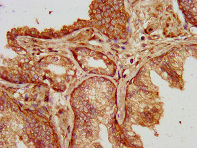 IHC image of SLC14A1 Antibody diluted at 1:200 and staining in paraffin-embedded human prostate cancer performed on a Leica BondTM system. After dewaxing and hydration, antigen retrieval was mediated by high pressure in a citrate buffer (pH 6.0). Section was blocked with 10% normal goat serum 30min at RT. Then primary antibody (1% BSA) was incubated at 4°C overnight. The primary is detected by a biotinylated secondary antibody and visualized using an HRP conjugated SP system.Rabbit anti-Human SLC14A1 Polyclonal Antibody