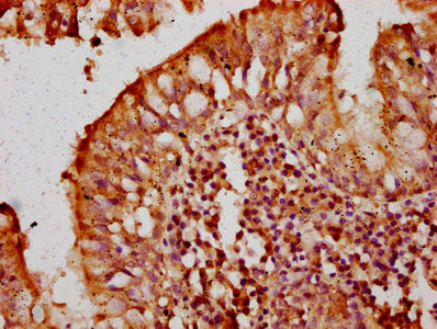 IHC image of the antibody diluted at 1:300 and staining in paraffin-embedded human lung tissue performed on a Leica BondTM system. After dewaxing and hydration, antigen retrieval was mediated by high pressure in a citrate buffer (pH 6.0). Section was blocked with 10% normal goat serum 30min at RT. Then primary antibody (1% BSA) was incubated at 4°C overnight. The primary is detected by a biotinylated secondary antibody and visualized using an HRP conjugated SP system.Rabbit anti-Human TCIRG1 Polyclonal Antibody
