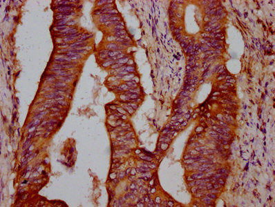 IHC image of TCIRG1 Antibody diluted at 1:300 and staining in paraffin-embedded human colon cancer performed on a Leica BondTM system. After dewaxing and hydration, antigen retrieval was mediated by high pressure in a citrate buffer (pH 6.0). Section was blocked with 10% normal goat serum 30min at RT. Then primary antibody (1% BSA) was incubated at 4°C overnight. The primary is detected by a biotinylated secondary antibody and visualized using an HRP conjugated SP system.Rabbit anti-Human TCIRG1 Polyclonal Antibody
