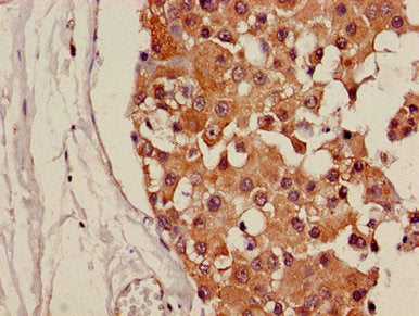 Immunohistochemistry of paraffin-embedded human breast cancer using CDH18 Antibody at dilution of 1:100Rabbit anti-Human CDH18 Polyclonal Antibody