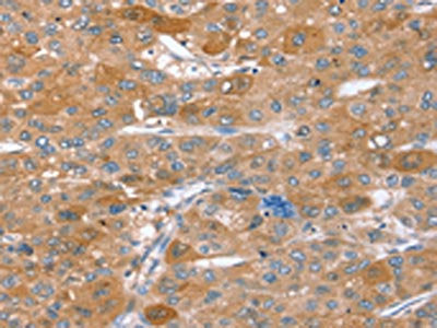 The image on the left is immunohistochemistry of paraffin-embedded Human liver cancer tissue using the antibody Antibody) at dilution 1/40, on the right is treated with synthetic peptide. (Original magnification: ×200)Rabbit anti-Human STX2 Polyclonal Antibody