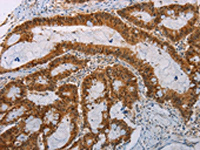 The image on the left is immunohistochemistry of paraffin-embedded Human colon cancer tissue using ACY1 Antibody(ACY1 Antibody) at dilution 1/25, on the right is treated with fusion protein. (Original magnification: ×200)Rabbit anti-Human ACY1 Polyclonal Antibody