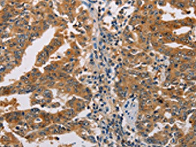 The image on the left is immunohistochemistry of paraffin-embedded Human gastic cancer tissue using the antibody Antibody) at dilution 1/25, on the right is treated with fusion protein. (Original magnification: ×200)Rabbit anti-Human ACY1 Polyclonal Antibody