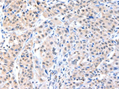 The image on the left is immunohistochemistry of paraffin-embedded Human breast cancer tissue using the antibody Antibody) at dilution 1/40, on the right is treated with fusion protein. (Original magnification: ×200)