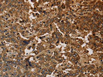 The image on the left is immunohistochemistry of paraffin-embedded Human liver cancer tissue using KRT16 Antibody(KRT16 Antibody) at dilution 1/30, on the right is treated with synthetic peptide. (Original magnification: ×200)