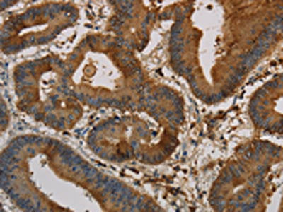 The image on the left is immunohistochemistry of paraffin-embedded Human colon cancer tissue using the antibody Antibody) at dilution 1/30, on the right is treated with synthetic peptide. (Original magnification: ×200)