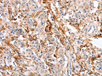 The image on the left is immunohistochemistry of paraffin-embedded Human gastric cancer tissue using SIGLEC9 Antibody(SIGLEC9 Antibody) at dilution 1/30, on the right is treated with fusion protein. (Original magnification: ×200)Rabbit anti-Human SIGLEC9 Polyclonal Antibody