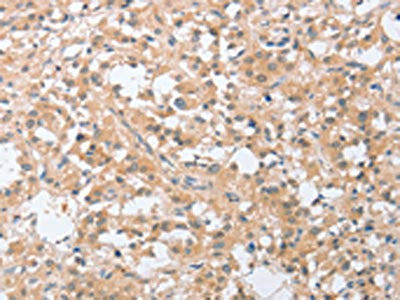 The image on the left is immunohistochemistry of paraffin-embedded Human thyroid cancer tissue using the antibody Antibody) at dilution 1/30, on the right is treated with fusion protein. (Original magnification: ×200)Rabbit anti-Human SIGLEC9 Polyclonal Antibody