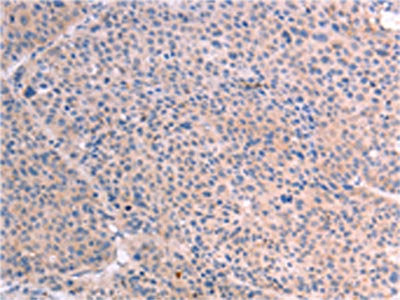 The image on the left is immunohistochemistry of paraffin-embedded Human liver cancer tissue using RELA Antibody(RELA Antibody) at dilution 1/25, on the right is treated with fusion protein. (Original magnification: ×200)Rabbit anti-Human RELA Polyclonal Antibody