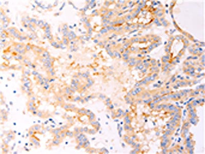 The image on the left is immunohistochemistry of paraffin-embedded Human thyroid cancer tissue using the antibody Antibody) at dilution 1/25, on the right is treated with fusion protein. (Original magnification: ×200)Rabbit anti-Human RELA Polyclonal Antibody