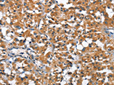 The image on the left is immunohistochemistry of paraffin-embedded Human thyroid cancer tissue using ARMCX2 Antibody(ARMCX2 Antibody) at dilution 1/40, on the right is treated with fusion protein. (Original magnification: ×200)