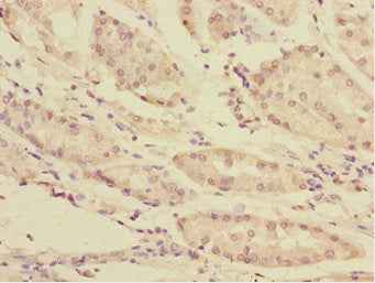 Immunohistochemistry of paraffin-embedded human gastric cancer using TOB2 Antibody at dilution of 1:100Rabbit anti-Human TOB2 Polyclonal Antibody