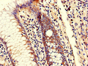 Immunohistochemistry of paraffin-embedded human colon cancer using TRIM25 Antibody at dilution of 1:100