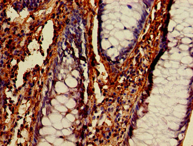 IHC image of BECN1 Antibody diluted at 1:400 and staining in paraffin-embedded human colon cancer performed on a Leica BondTM system. After dewaxing and hydration, antigen retrieval was mediated by high pressure in a citrate buffer (pH 6.0). Section was blocked with 10% normal goat serum 30min at RT. Then primary antibody (1% BSA) was incubated at 4°C overnight. The primary is detected by a biotinylated secondary antibody and visualized using an HRP conjugated SP system.