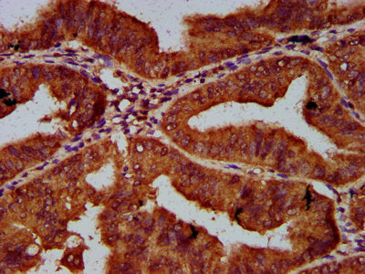 IHC image of the antibody diluted at 1:600 and staining in paraffin-embedded human endometrial cancer performed on a Leica BondTM system. After dewaxing and hydration, antigen retrieval was mediated by high pressure in a citrate buffer (pH 6.0). Section was blocked with 10% normal goat serum 30min at RT. Then primary antibody (1% BSA) was incubated at 4°C overnight. The primary is detected by a biotinylated secondary antibody and visualized using an HRP conjugated SP system.Rabbit anti-Human CUL7 Polyclonal Antibody