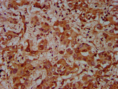 IHC image of CUL7 Antibody diluted at 1:600 and staining in paraffin-embedded human liver cancer performed on a Leica BondTM system. After dewaxing and hydration, antigen retrieval was mediated by high pressure in a citrate buffer (pH 6.0). Section was blocked with 10% normal goat serum 30min at RT. Then primary antibody (1% BSA) was incubated at 4°C overnight. The primary is detected by a biotinylated secondary antibody and visualized using an HRP conjugated SP system.Rabbit anti-Human CUL7 Polyclonal Antibody