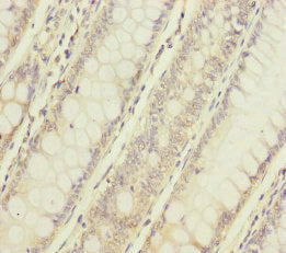 Immunohistochemistry of paraffin-embedded human colon cancer using NAA25 Antibody at dilution of 1:100Rabbit anti-Human NAA25 Polyclonal Antibody