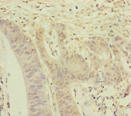 Immunohistochemistry of paraffin-embedded human colon cancer using NAA25 Antibody at dilution of 1:100Rabbit anti-Human NAA25 Polyclonal Antibody