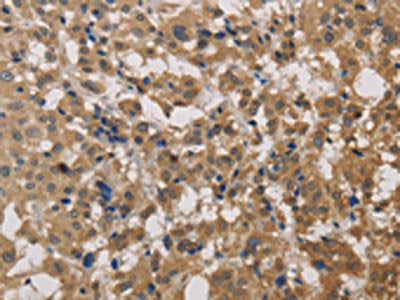 The image on the left is immunohistochemistry of paraffin-embedded Human thyroid cancer tissue using DEGS1 Antibody(DEGS1 Antibody) at dilution 1/40, on the right is treated with fusion protein. (Original magnification: ×200)Rabbit anti-Human DEGS1 Polyclonal Antibody