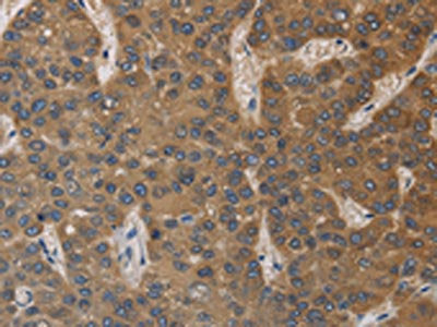 The image on the left is immunohistochemistry of paraffin-embedded Human liver cancer tissue using the antibody Antibody) at dilution 1/40, on the right is treated with fusion protein. (Original magnification: ×200)Rabbit anti-Human DEGS1 Polyclonal Antibody