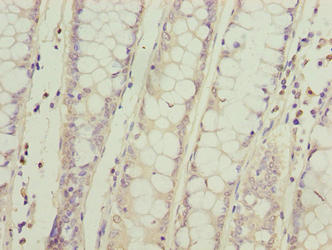 Immunohistochemistry of paraffin-embedded human colon cancer using the antibody at dilution of 1:100Rabbit anti-Human SPCS2 Polyclonal Antibody