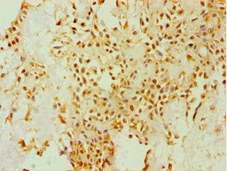 Immunohistochemistry of paraffin-embedded human breast cancer using DHCR24 Antibody at dilution of 1:100Rabbit anti-Human DHCR24 Polyclonal Antibody