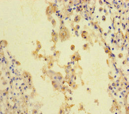 Immunohistochemistry of paraffin-embedded human lung cancer using the antibody at dilution of 1:100Rabbit anti-Human STIL Polyclonal Antibody