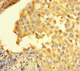 Immunohistochemistry of paraffin-embedded human breast cancer using STIL Antibody at dilution of 1:100Rabbit anti-Human STIL Polyclonal Antibody
