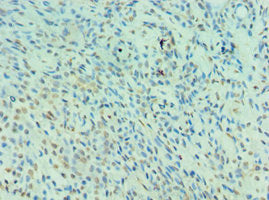 Immunohistochemistry of paraffin-embedded human breast cancer using NEDD8 Antibody at dilution of 1:100Rabbit anti-Human NEDD8 Polyclonal Antibody