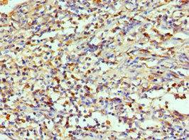 Immunohistochemistry of paraffin-embedded human cervical cancer using AIMP1 Antibody at dilution of 1:100Rabbit anti-Human AIMP1 Polyclonal Antibody