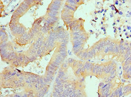 Immunohistochemistry of paraffin-embedded human colon cancer using AIMP1 Antibody at dilution of 1:100Rabbit anti-Human AIMP1 Polyclonal Antibody