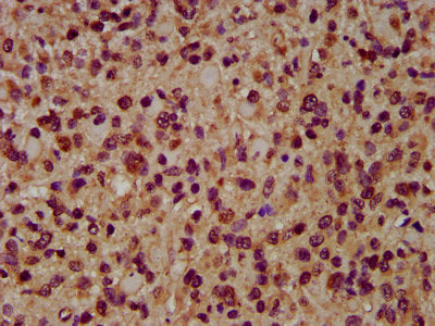 IHC image of AIMP1 Antibody diluted at 1:200 and staining in paraffin-embedded human glioma performed on a Leica BondTM system. After dewaxing and hydration, antigen retrieval was mediated by high pressure in a citrate buffer (pH 6.0). Section was blocked with 10% normal goat serum 30min at RT. Then primary antibody (1% BSA) was incubated at 4°C overnight. The primary is detected by a biotinylated secondary antibody and visualized using an HRP conjugated SP system.Rabbit anti-Human AIMP1 Polyclonal Antibody