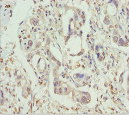 Immunohistochemistry of paraffin-embedded human pancreatic cancer using PPP1R8 Antibody at dilution of 1:100Rabbit anti-Human PPP1R8 Polyclonal Antibody
