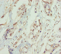 Immunohistochemistry of paraffin-embedded human pancreatic cancer using PPP1R8 Antibody at dilution of 1:100Rabbit anti-Human PPP1R8 Polyclonal Antibody