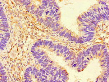 Immunohistochemistry of paraffin-embedded human ovarian cancer using PRKAA1 Antibody at dilution of 1:100Rabbit anti-Human PRKAA1 Polyclonal Antibody