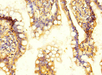 Immunohistochemistry of paraffin-embedded human colon cancer using SLC13A2 Antibody at dilution of 1:100Rabbit anti-Human SLC13A2 Polyclonal Antibody