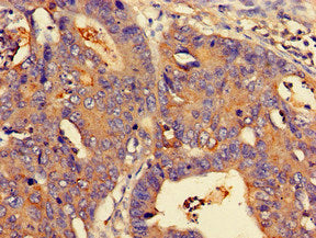 Immunohistochemistry of paraffin-embedded human colon cancer using NMI Antibody at dilution of 1:100Rabbit anti-Human NMI Polyclonal Antibody