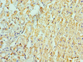 Immunohistochemistry of paraffin-embedded human liver cancer using ADAM9 Antibody at dilution of 1:100