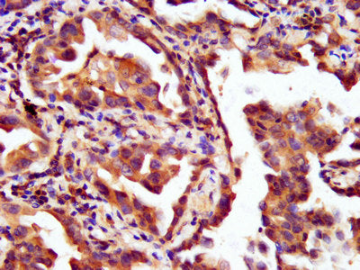 IHC image of LAMC2 Antibody diluted at 1:200 and staining in paraffin-embedded human lung cancer performed on a Leica BondTM system. After dewaxing and hydration, antigen retrieval was mediated by high pressure in a citrate buffer (pH 6.0). Section was blocked with 10% normal goat serum 30min at RT. Then primary antibody (1% BSA) was incubated at 4°C overnight. The primary is detected by a biotinylated secondary antibody and visualized using an HRP conjugated SP system.Rabbit anti-Human LAMC2 Polyclonal Antibody