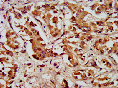 IHC image of LAMC2 Antibody diluted at 1:200 and staining in paraffin-embedded human liver cancer performed on a Leica BondTM system. After dewaxing and hydration, antigen retrieval was mediated by high pressure in a citrate buffer (pH 6.0). Section was blocked with 10% normal goat serum 30min at RT. Then primary antibody (1% BSA) was incubated at 4°C overnight. The primary is detected by a biotinylated secondary antibody and visualized using an HRP conjugated SP system.Rabbit anti-Human LAMC2 Polyclonal Antibody