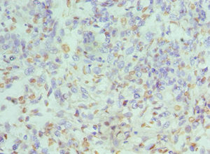 Immunohistochemistry of paraffin-embedded human endometrial cancer using HNRNPD Antibody at dilution of 1:100Rabbit anti-Human HNRNPD Polyclonal Antibody