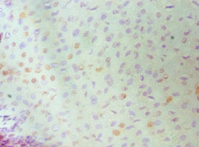 Immunohistochemistry of paraffin-embedded human cervical cancer using MCM6 Antibody at dilution of 1:100