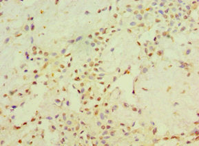 Immunohistochemistry of paraffin-embedded human breast cancer using STARD3 Antibody at dilution of 1:100Rabbit anti-Human STARD3 Polyclonal Antibody