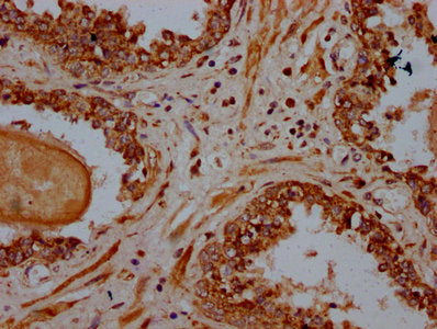 IHC image of PSME4 Antibody diluted at 1:600 and staining in paraffin-embedded human prostate cancer performed on a Leica BondTM system. After dewaxing and hydration, antigen retrieval was mediated by high pressure in a citrate buffer (pH 6.0). Section was blocked with 10% normal goat serum 30min at RT. Then primary antibody (1% BSA) was incubated at 4°C overnight. The primary is detected by a biotinylated secondary antibody and visualized using an HRP conjugated SP system.Rabbit anti-Human PSME4 Polyclonal Antibody