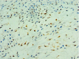 Immunohistochemistry of paraffin-embedded human berast cancer using PDK2 Antibody at dilution of 1:100Rabbit anti-Human PDK2 Polyclonal Antibody